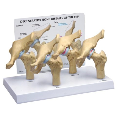 変形性股関節症・骨粗鬆症 ，4段階モデル