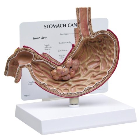 胃がんモデル