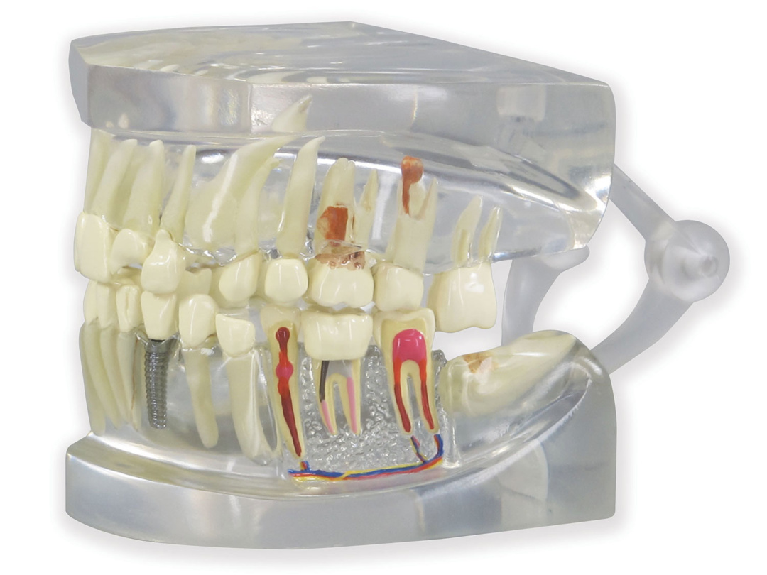 デンタルモデル 歯医者 歯の模型 透明 標本 見本 親知らず