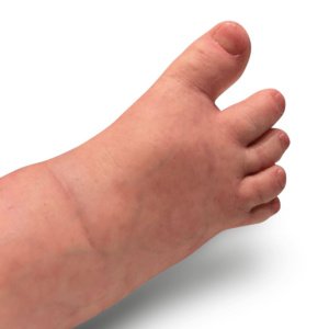 足の親指と人差し指の広い間隔